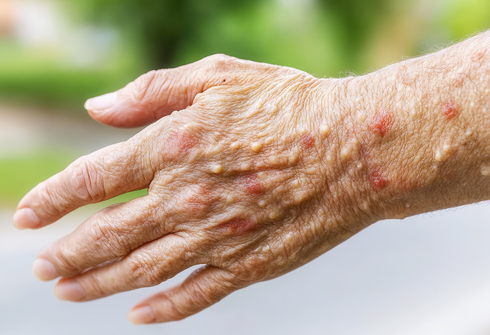 Isenção de Imposto de Renda por Hanseníase: O Direito além da Cura